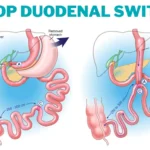 Loop Duodenal Switch