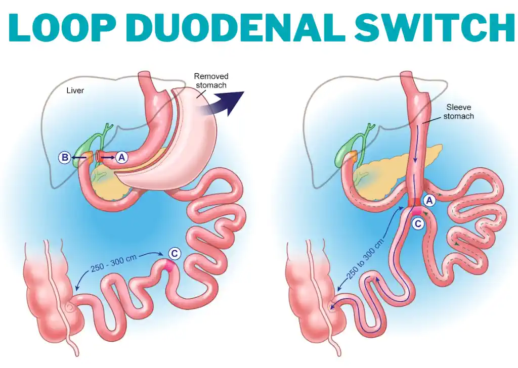 Loop Duodenal Switch