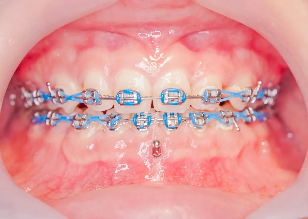 Orthodontic Mini Implants